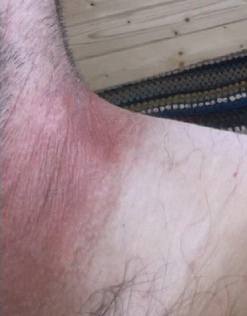Side effects of caffeine – my morning cup turned my neck red 2 Bad skin with coffee and caffeine