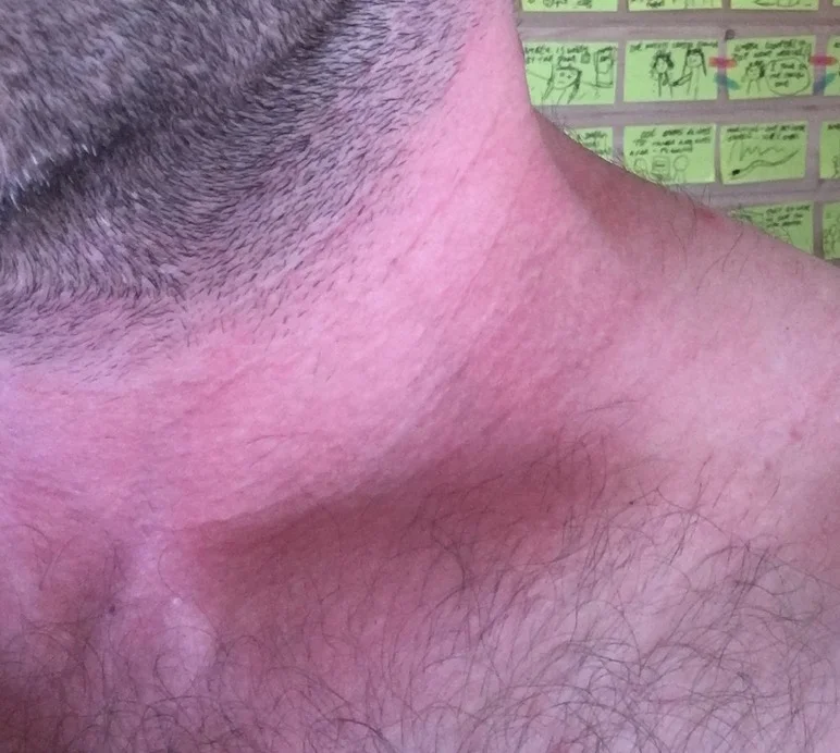 Side effects of caffeine – my morning cup turned my neck red 3 Is caffeine bad for you